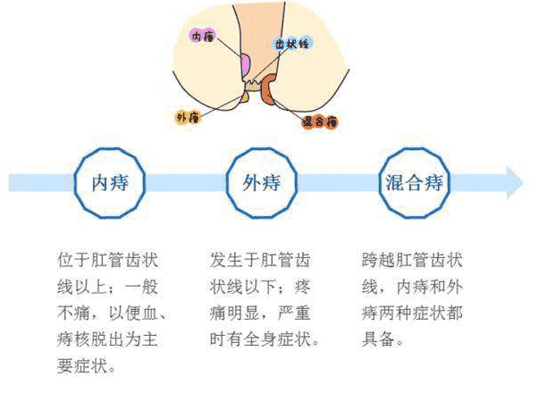 武漢江漢博仕醫(yī)院 痔瘺和痔瘡是一個病嗎