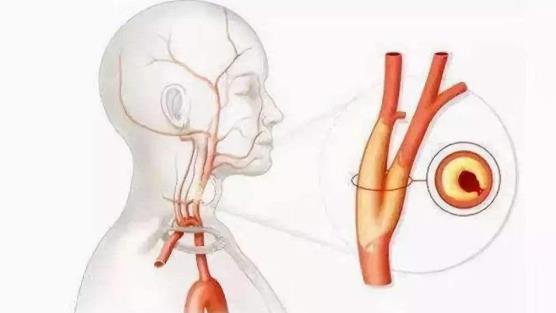 血管狹窄是什么意思？血管狹窄可以恢復(fù)嗎？