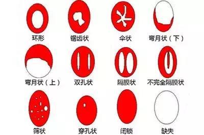 14歲女孩處女膜長什么樣？14歲女孩有處女膜嗎？[圖]