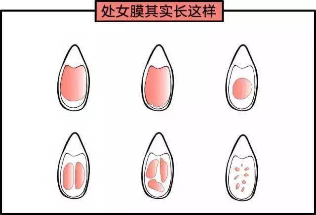 14歲女孩處女膜長什么樣？14歲女孩有處女膜嗎？[圖]