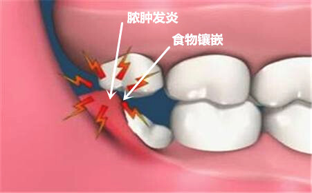 牙菌斑以及食物殘渣等容易對拔智齒的創(chuàng)口造成感染。