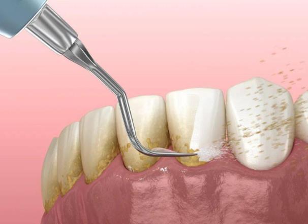 牙結(jié)石一次能完全洗干凈嗎？不想洗牙怎么去牙結(jié)石