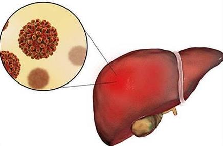 肝病怎么徹底治好？如何預(yù)防肝病