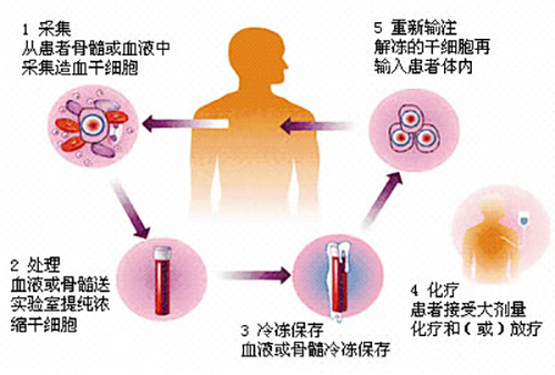 濟(jì)南血液病醫(yī)院科普：骨髓瘤患者自體移植前需要做好哪些準(zhǔn)備？