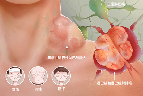 濟(jì)南血液病醫(yī)院科普：確診淋巴瘤該如何治療？自體移植效果好嗎？