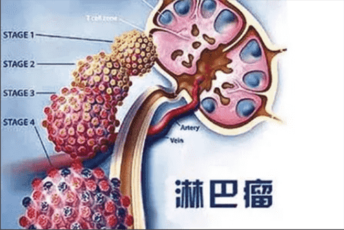 濟(jì)南血液病醫(yī)院科普：治療非霍奇金淋巴瘤，化療、移植哪個(gè)好？