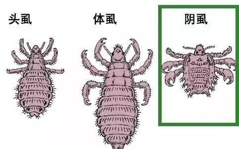 本文目錄 1、長了陰虱怎么辦 2、陰虱的臨床癥狀 3、如何預(yù)防陰虱