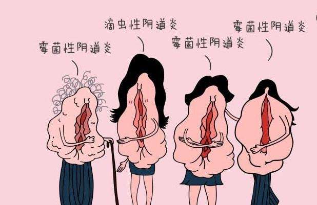 女性在生活中怎樣預(yù)防女性私處炎癥？女性私處炎反復(fù)發(fā)作原因[圖]