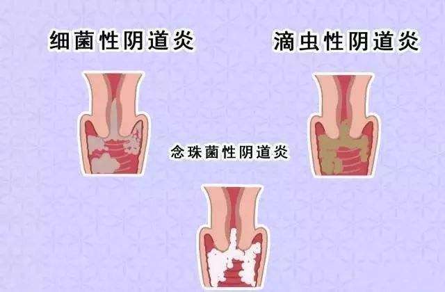 霉菌性陰道炎的表現(xiàn)有哪些？日常需要怎樣護(hù)理？[圖]