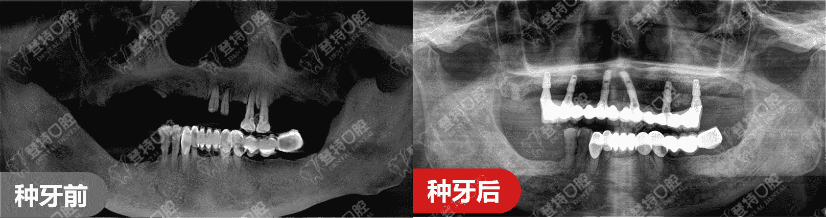 顛覆傳統(tǒng)種牙，佛山登特口腔一日得技術，一天搞定種牙全過程