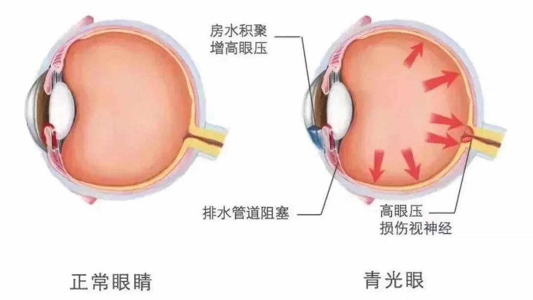 【合肥愛爾】專家提醒：慎防青光眼