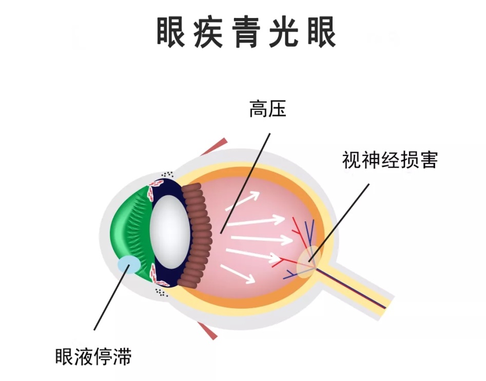 合肥愛(ài)爾眼科：青光眼預(yù)防一定要“早”