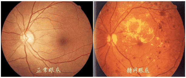 合肥愛爾眼科醫(yī)院：糖尿病患者，注意定期檢查眼底