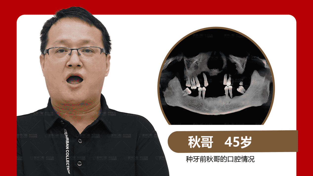 佛山登特口腔：全口半口缺牙修復(fù)方式怎么選？