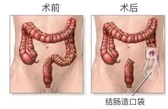 貴陽(yáng)東大肛腸醫(yī)院：30歲小伙每天大便兩三次，確診腸癌！醫(yī)生呼吁：這些人應(yīng)