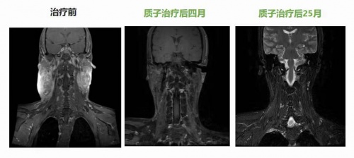 腫瘤放療“皇冠上的明珠”質子治療，竟比普通放療更“省錢”