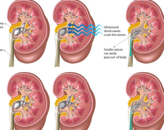 腎結(jié)石怎么引起的 排泄功能故障尿酸多草酸沉淀多