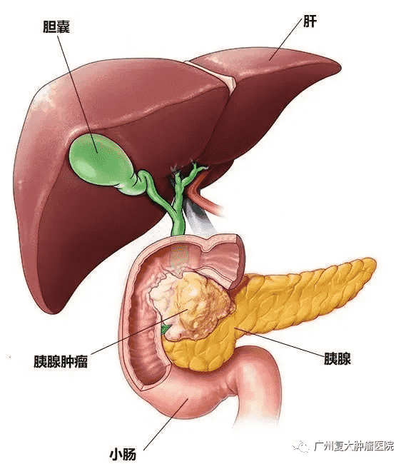 杭州腫瘤醫(yī)院選擇廣州復(fù)大腫瘤醫(yī)院：納米刀可以治療胰腺癌嗎