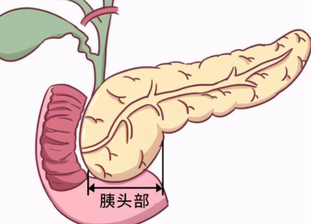 胰腺癌晚期能活多久 發(fā)病率低預(yù)后難3-6個(gè)月