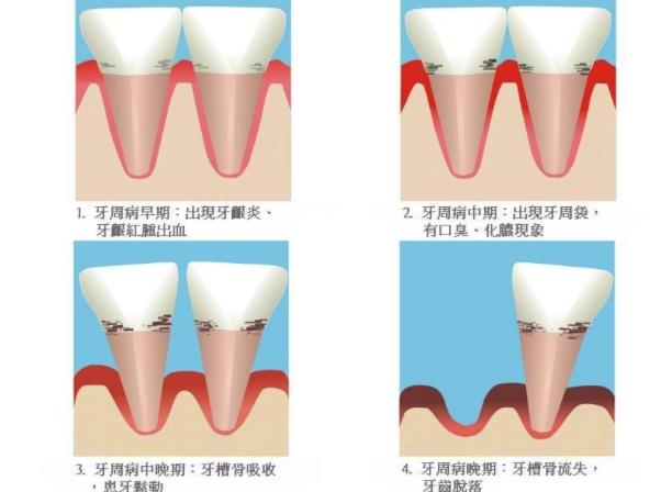 牙周炎怎么治療 藥物去除牙石殺菌手術(shù)