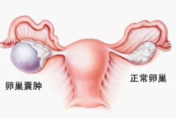 巧克力囊腫能懷上孩子嗎 不孕率高達(dá)50％及時(shí)治療