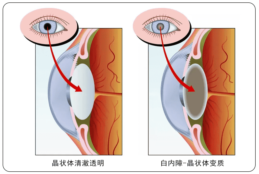 重慶高溫天氣下，普瑞眼科內(nèi)購會護(hù)眼福利來襲