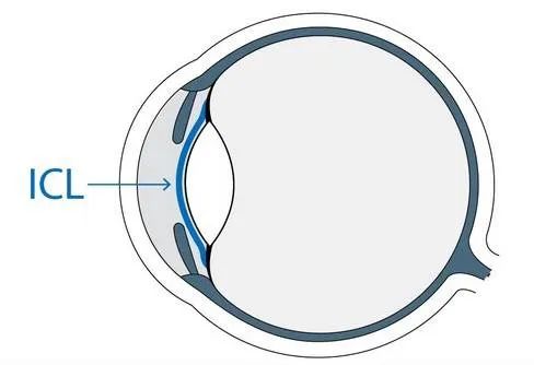 劉保松博士談ICL晶體植入?：同樣是近視手術(shù)，ICL為什么那么貴？
