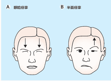 長安面神經(jīng)醫(yī)院居劍峰：口眼聯(lián)動是面肌痙攣嗎