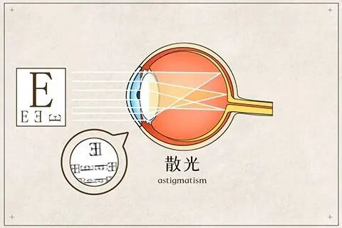 劉保松博士談ICL晶體植入?：近視+散光，選激光手術還是ICL?