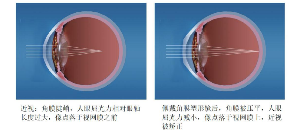 番禺普瑞科學(xué)配鏡總動員 OK鏡控制近視增長非常OK