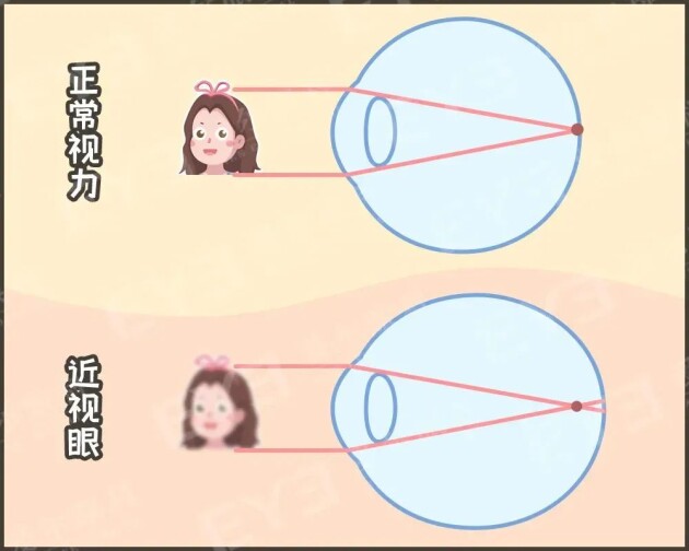 孩子戴上眼鏡度數(shù)會越來越高，確實如此嗎？——合肥愛爾眼科