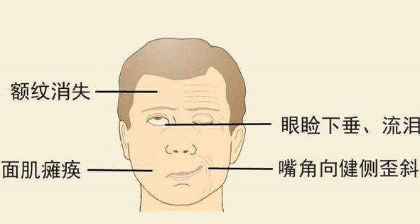 北京廣濟醫(yī)院怎么樣，治療面癱找對科室少走彎路