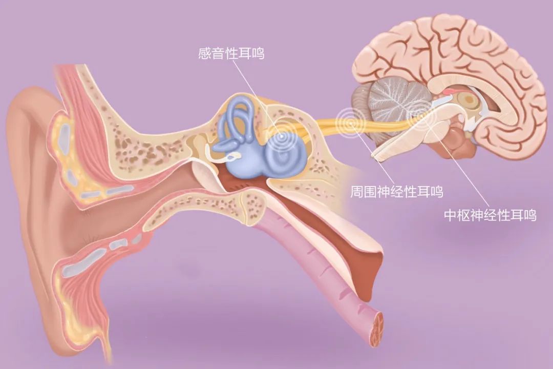 “嚶嚶嚶…”，成都民生耳鼻喉醫(yī)院提醒：耳鳴是身體的警報(bào)，須重視！