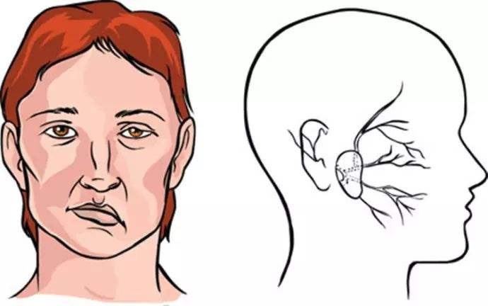 上海健橋醫(yī)院好不好，面癱的兩種常見癥狀和治療方法