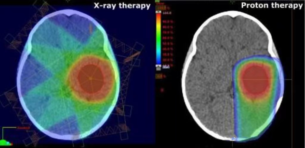 直播科普|質(zhì)子治療為什么是兒童腫瘤放療的“金標準”