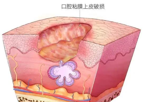 怎么治療口腔潰瘍有效 如何預防口腔潰瘍