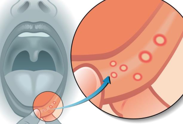 口腔潰瘍會(huì)遺傳嗎 不受年齡地域性別限制