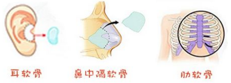 余文林唇裂修復團隊：耳軟骨和肋軟骨哪個做修復更好？