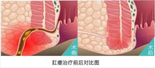 廣州東大肛腸醫(yī)院可信嗎肛瘺術后要想恢復快，這5點很重要