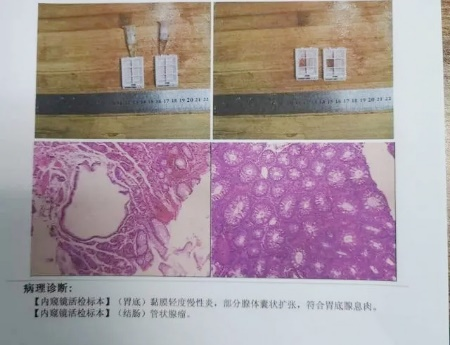 廣州東大肛腸醫(yī)院好不好34歲女士腸息肉切除后3年不查，拖出腸癌