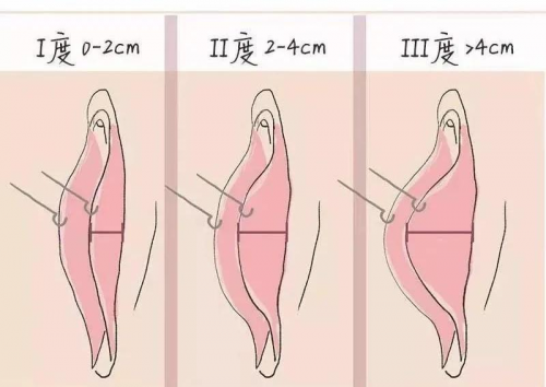 陰唇肥大又看不見，手術(shù)還有必要做嗎？在昆明這里告訴你!