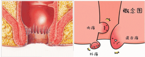 廣州東大肛醫(yī)院這樣區(qū)分內(nèi)痔外痔混合痔可信嗎？