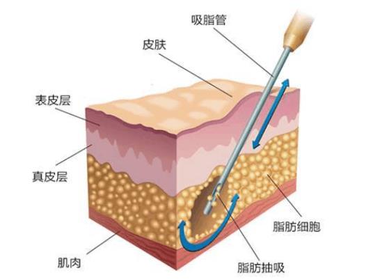 吸脂肪對身體有害嗎 吸脂肪手術(shù)需要多少錢