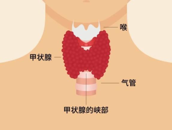 甲狀腺結(jié)節(jié)有什么癥狀 甲狀腺結(jié)節(jié)伴鈣化什么意思