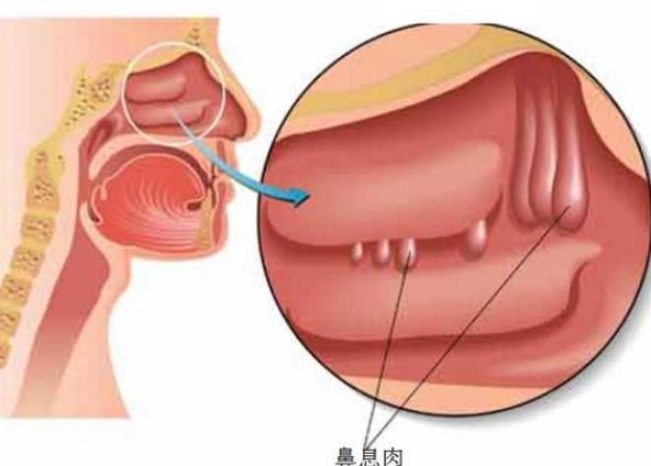 鼻息肉可以做手術(shù)嗎 鼻息肉吃藥有效嗎