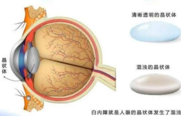 白內障做手術有效嗎 白內障手術有哪些風險