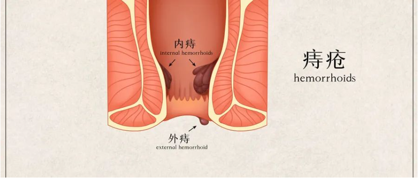 【北京豐益肛腸醫(yī)院】導(dǎo)致炎性外痔的主要原因有哪些？