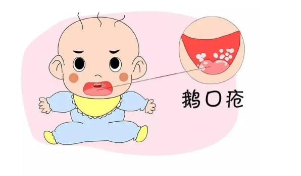 鵝口瘡是怎么引起的？寶寶得鵝口瘡怎么護(hù)理？