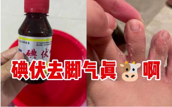 碘伏能治療腳氣嗎？腳氣是缺乏維生素嗎？