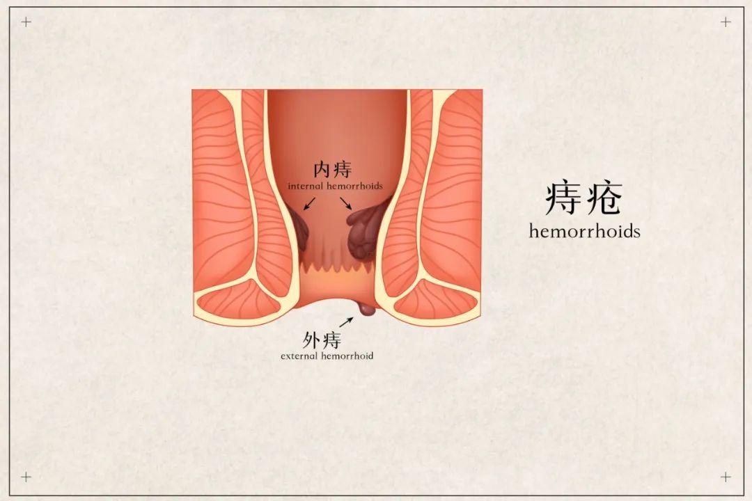 包頭東大肛腸?？漆t(yī)院詳解痔瘡與肛裂如何區(qū)分